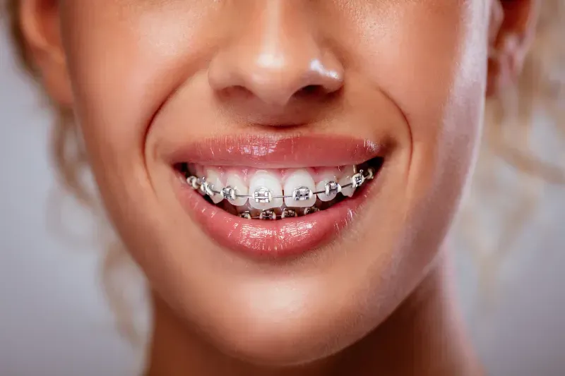 braces pediatric orthodontist citrus park odessa